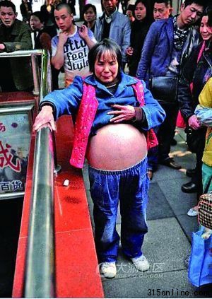 因凑不齐治大肚病的5万元,她只能强忍病痛。(网友供图)图片来源:重庆晨报 因凑不齐治大肚病的5万元,她只能强忍病痛。(网友供图)图片来源:重庆晨报