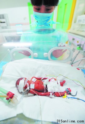 袖珍婴儿出生体重仅500克捧起他像捧块豆腐(图)